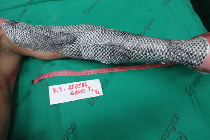 Doctors using fish skin to heal burn wounds